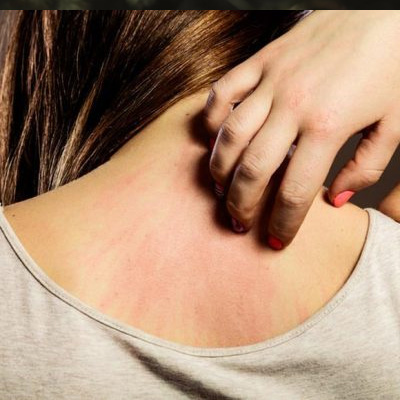 Hot Tub Rash (Folliculitis)